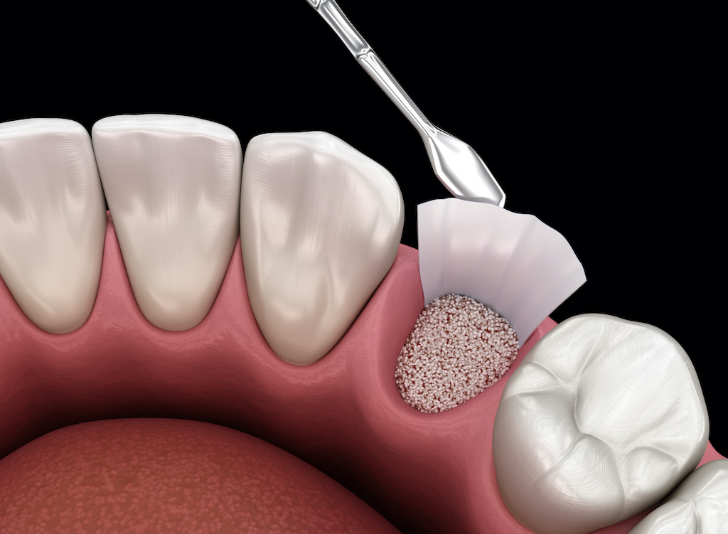 Bone Grafting Rolla Oral Surgery